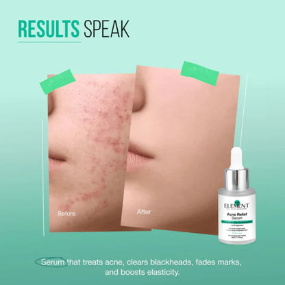 The Element Acne Relief Serum – Clear Acne, Control Oil & Reveal Clearer Skin – Triple Action Acne Defense – Fights Acne, Controls Oil, Minimizes Pores, Fades Marks