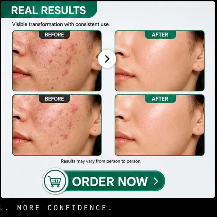 The Element Acne Relief Serum – Clear Acne, Control Oil & Reveal Clearer Skin – Triple Action Acne Defense – Fights Acne, Controls Oil, Minimizes Pores, Fades Marks