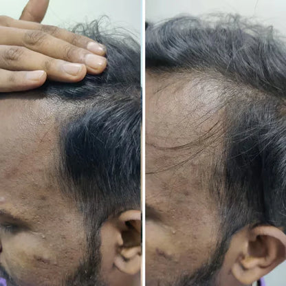 Rosemary Advanced Hair Growth Serum for Pattern Baldness | Promotes New Hair Growth
