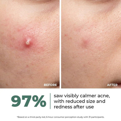 Rapid Relief Acne Spot Corrector Gel (15g)| Triple-Action Treatment For Men & Women