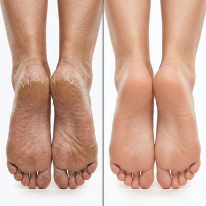 Rozino Tea Tree Oil Foot Cream | Vitamin E, Aloe Vera & Peppermint | Repairs Cracked Heels, Rough Elbows & Dry Knees | Intense Hydration