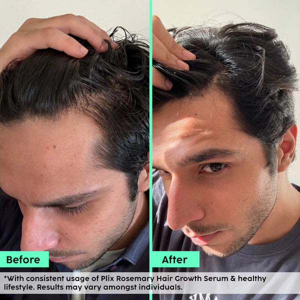 Rosemary Advanced Hair Growth Serum for Pattern Baldness | Promotes New Hair Growth
