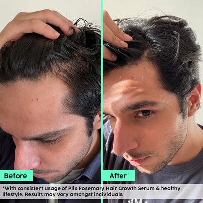 Rosemary Advanced Hair Growth Serum for Pattern Baldness | Promotes New Hair Growth